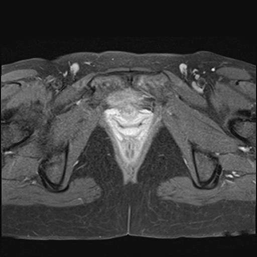 File:Bilateral ovarian endometriomas (Radiopaedia 87085-103347 Axial T1 C+ fat sat 20).jpg