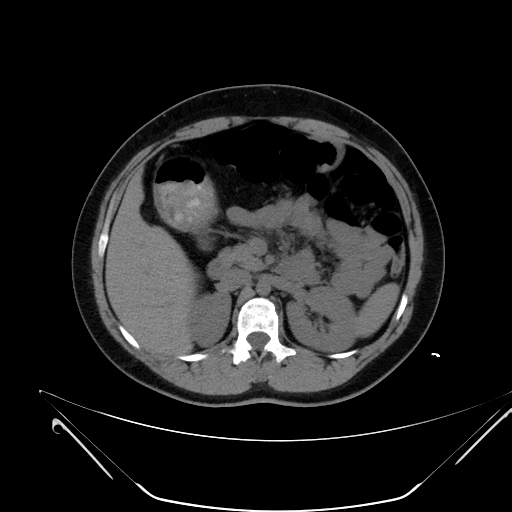 Bilateral ovarian mature cystic teratomas (Radiopaedia 79373-92457 Axial non-contrast 12).jpg