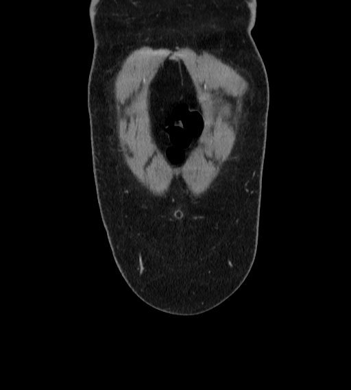 Bilateral ovarian mature cystic teratomas (Radiopaedia 79373-92457 B 1).jpg