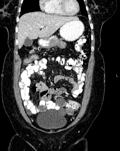Bilateral ovarian serous cystadenocarcinoma (Radiopaedia 86062-101989 D 8).jpg
