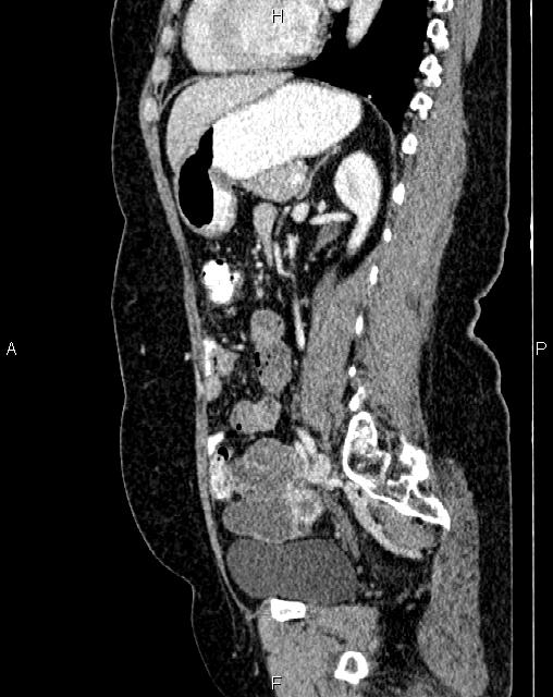 Bilateral ovarian serous cystadenocarcinoma (Radiopaedia 86062-101989 E 54).jpg