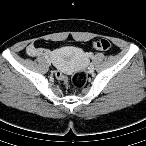 Bilateral ovarian teratoma (Radiopaedia 83131-97503 B 36).jpg