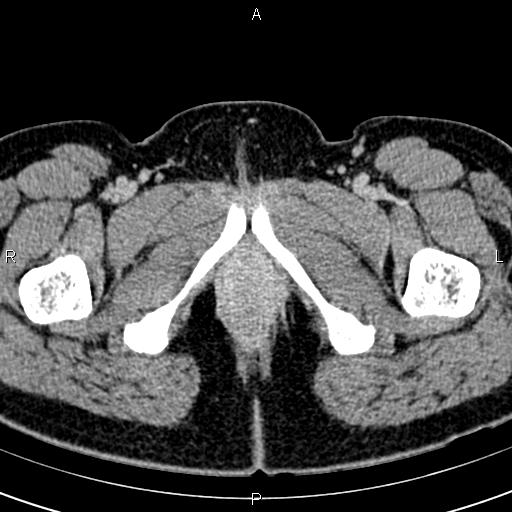 Bilateral ovarian teratoma (Radiopaedia 83131-97503 B 88).jpg