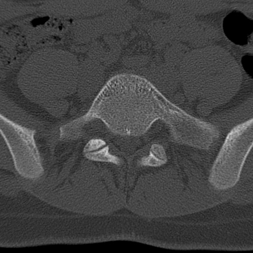 Bilateral pars defect (Radiopaedia 26691-26846 Axial bone window 62).jpg