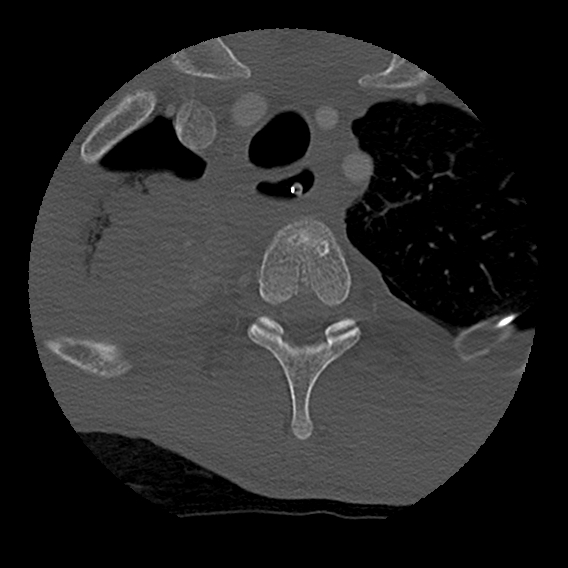 File:Bilateral perched facets with cord injury (Radiopaedia 45587-49713 Axial bone window 116).jpg