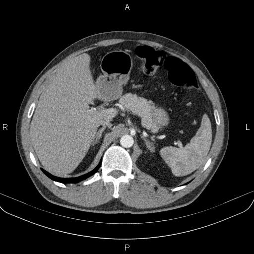 Bilateral pulmonary AVM (Radiopaedia 83134-97505 A 75).jpg