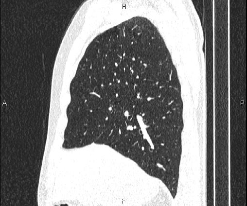 Bilateral pulmonary AVM (Radiopaedia 83134-97505 Sagittal lung window 41).jpg