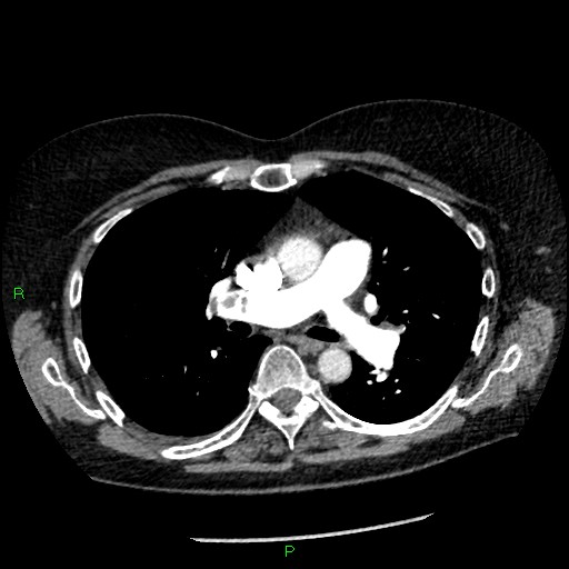 Bilateral pulmonary emboli (Radiopaedia 32700-33669 Axial C+ CTPA 48).jpg