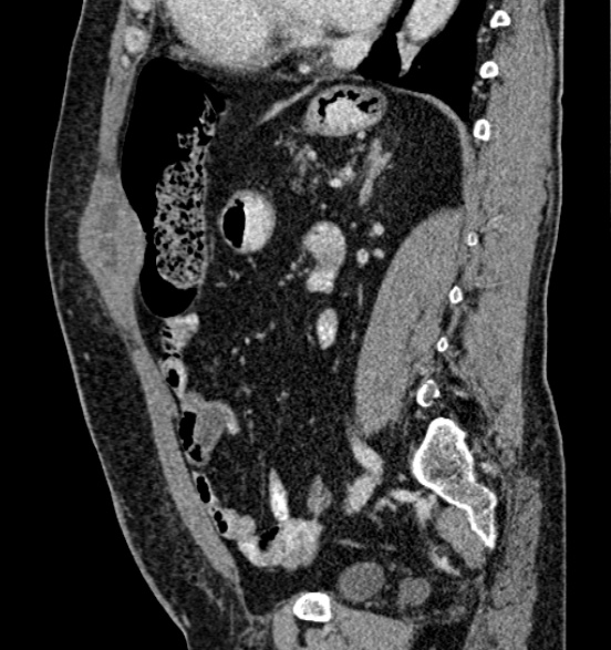 Bilateral rectus sheath hematomas (Radiopaedia 50778-56252 B 50).jpg
