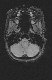 Bilateral subdural hemorrhage and parietal skull fracture (Radiopaedia 26058-26190 Axial SWI 8).png