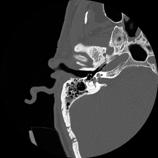 File:Bilateral temporal bone fractures (Radiopaedia 29482-29970 Axial non-contrast 19).jpg