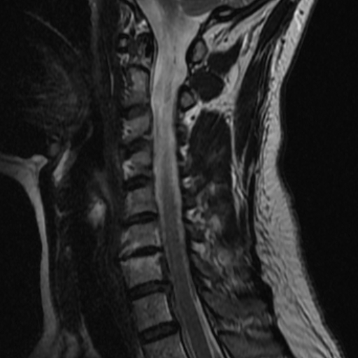 File:Bilateral tortuous vertebral arteries (Radiopaedia 19070-19039 Sagittal T2 5).jpg