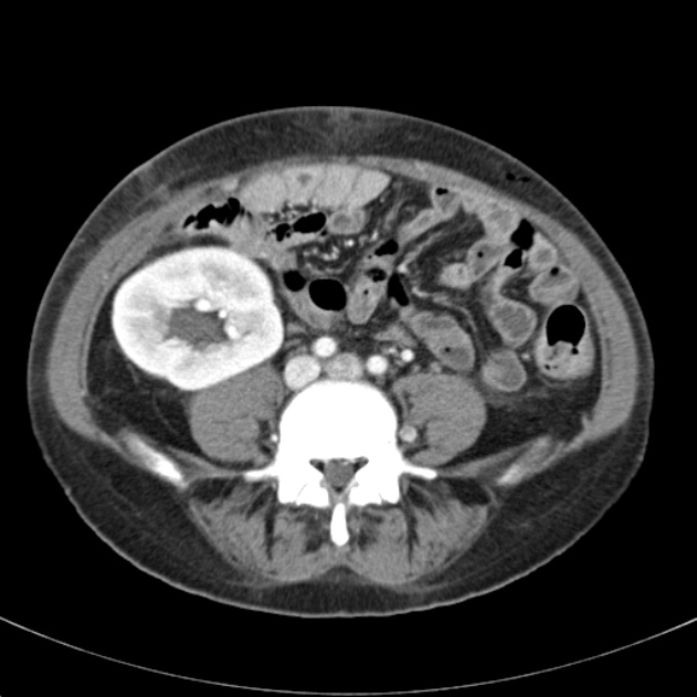 Biliary necrosis - liver transplant (Radiopaedia 21876-21846 B 50).jpg