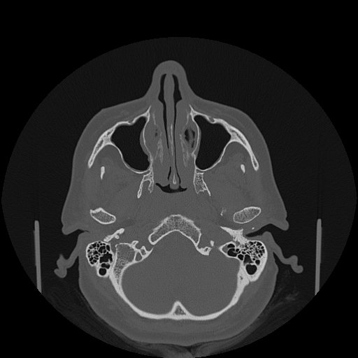 File:Bisphosphonate-related osteonecrosis of the jaw (Radiopaedia 71324-81642 Axial bone window 142).jpg