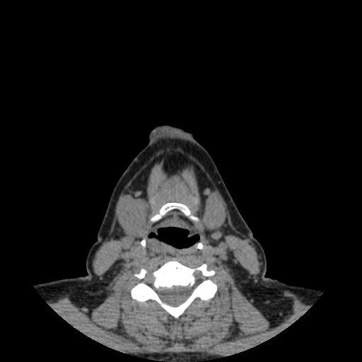 Bisphosphonate-related osteonecrosis of the jaw (Radiopaedia 71324-81642 non-contrast 1).jpg