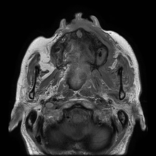 Bisphosphonate-related osteonecrosis of the maxilla (Radiopaedia 51367-57101 Axial T1 25).jpg