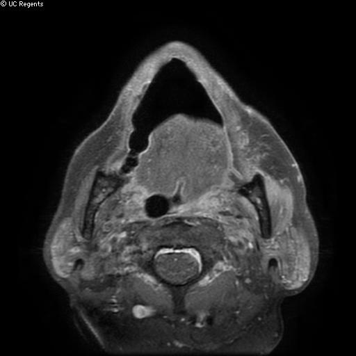 File:Bisphosphonate-related osteonecrosis of the maxilla (Radiopaedia 51367-57101 Axial T1 C+ fat sat 11).jpg