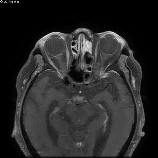 Bisphosphonate-related osteonecrosis of the maxilla (Radiopaedia 51367-57101 Axial T1 C+ fat sat 37).jpg