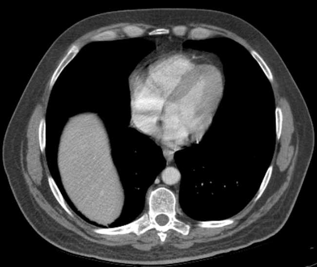 File:Bleeding duodenal ulcer and adenomyomatosis of gallbladder (Radiopaedia 61834-69861 A 5).jpg