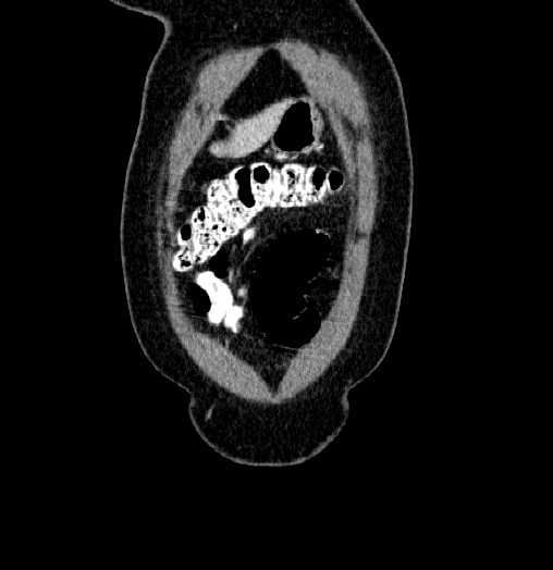 Blind-ending branch of a bifid ureter (Radiopaedia 61159-69048 C 5).jpg