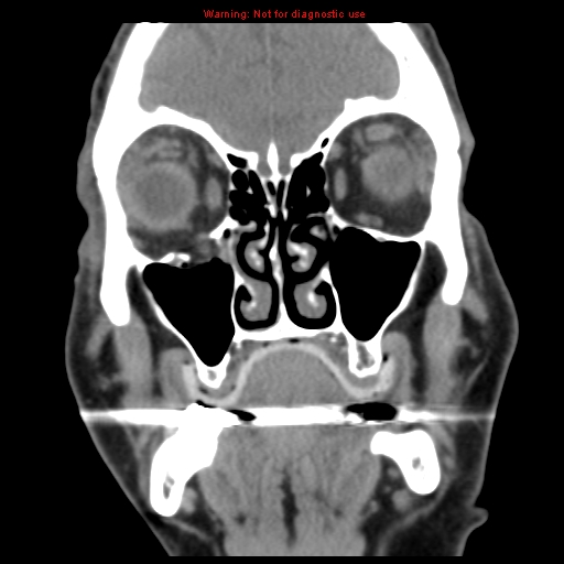 File:Blowout fracture with inferior rectus entrapment (Radiopaedia 12418-12673 Coronal non-contrast 9).jpg