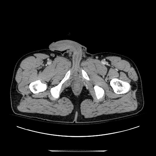 Blunt abdominal trauma with solid organ and musculoskelatal injury with active extravasation (Radiopaedia 68364-77895 A 168).jpg