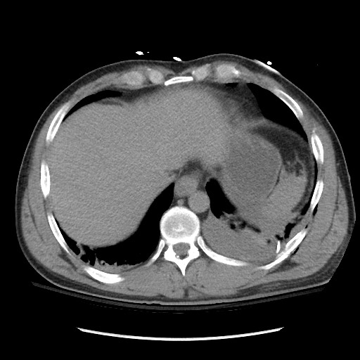 Blunt abdominal trauma with solid organ and musculoskelatal injury with active extravasation (Radiopaedia 68364-77895 Axial C+ delayed 20).jpg