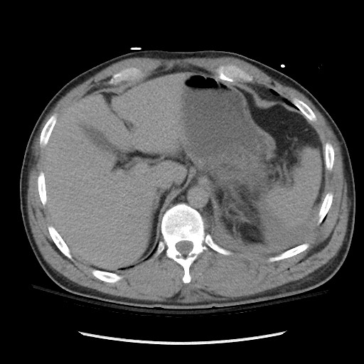 Blunt abdominal trauma with solid organ and musculoskelatal injury with active extravasation (Radiopaedia 68364-77895 Axial C+ delayed 31).jpg