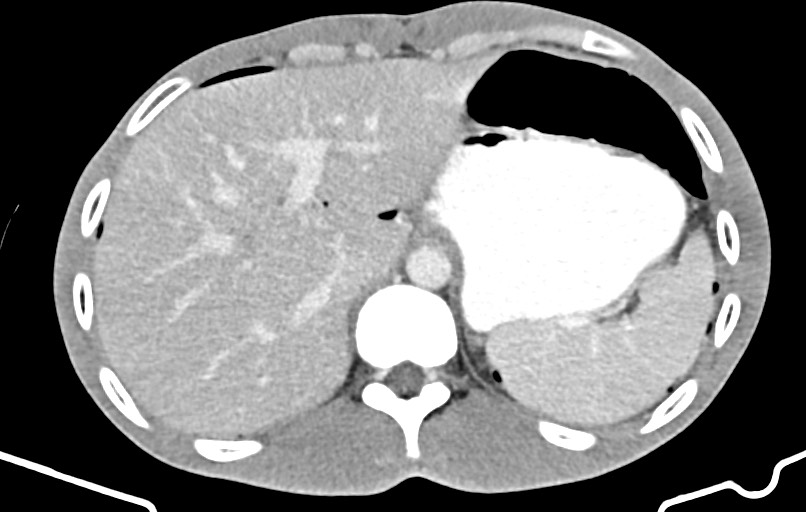 Blunt injury to the small bowel (Radiopaedia 74953-85987 A 19).jpg