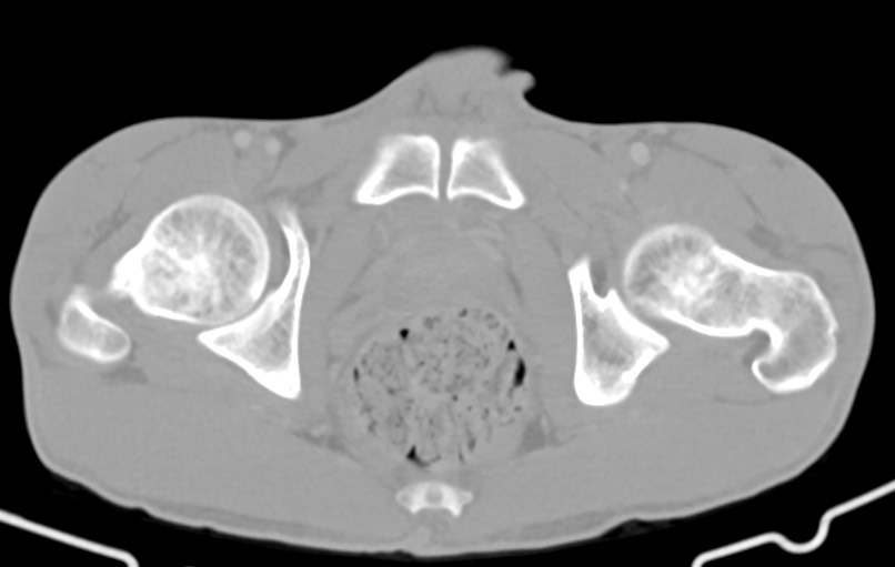 Blunt injury to the small bowel (Radiopaedia 74953-85987 Axial Wide 96).jpg