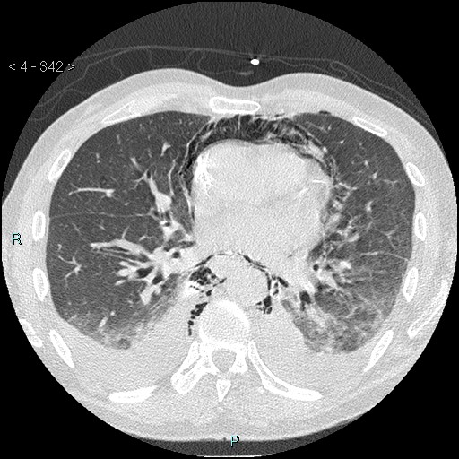 Boerhaave syndrome (Radiopaedia 27683-27897 lung window 50).jpg