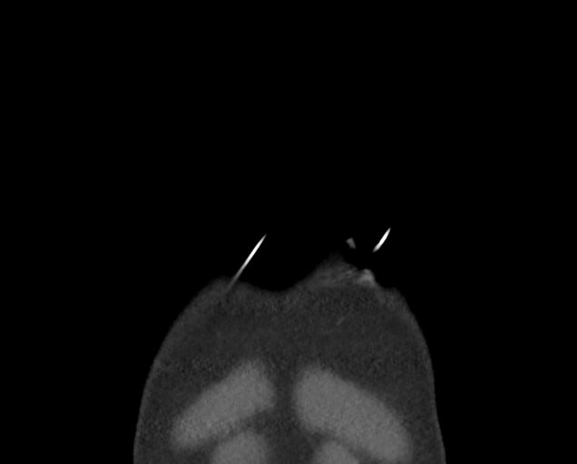 Boerhaave syndrome (Radiopaedia 39382-41660 C 4).png