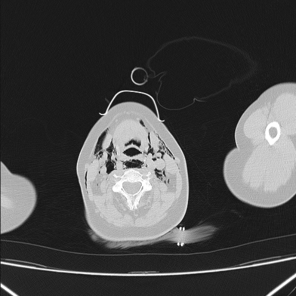 Boerhaave syndrome (Radiopaedia 45644-49799 Axial lung window 1).jpg