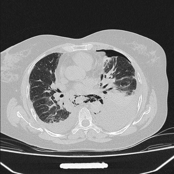 Boerhaave syndrome (Radiopaedia 45644-49799 Axial lung window 66).jpg