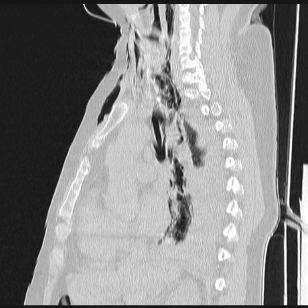Boerhaave syndrome (Radiopaedia 45644-49799 Sagittal lung window 36).jpg
