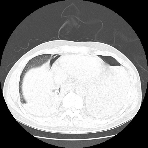 Boerhaave syndrome (Radiopaedia 59796-67310 Axial lung window 48).jpg