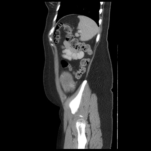 Borderline mucinous tumor (ovary) (Radiopaedia 78228-90808 B 54).jpg