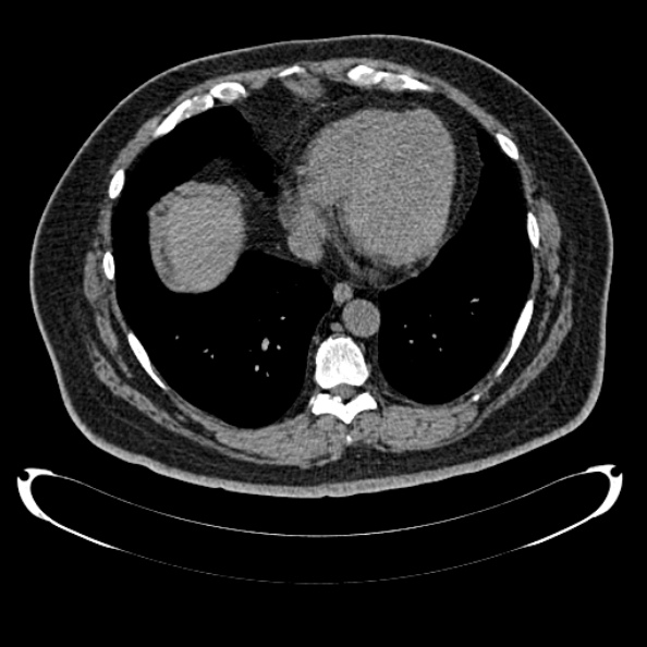 Bosniak renal cyst - type IV (Radiopaedia 24244-24518 Axial non-contrast 9).jpg