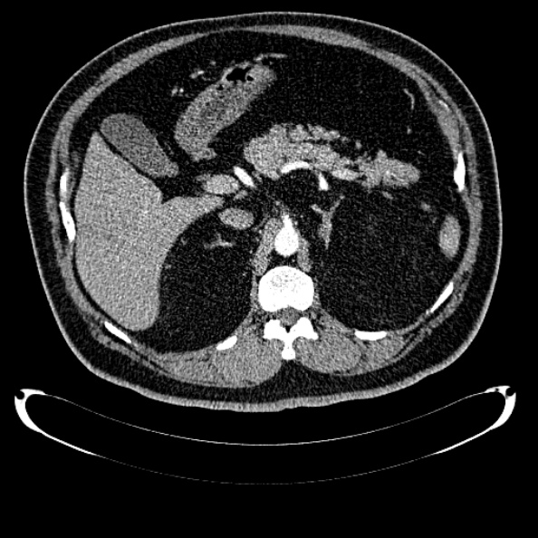 File:Bosniak renal cyst - type IV (Radiopaedia 24244-24518 B 97).jpg