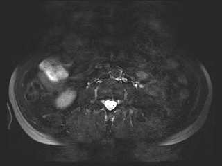 File:Bouveret syndrome (Radiopaedia 61017-68856 Axial MRCP 46).jpg