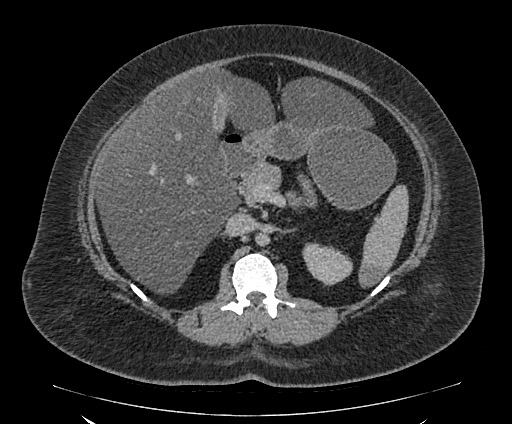Bowel and splenic infarcts in acute lymphocytic leukemia (Radiopaedia 61055-68913 A 52).jpg