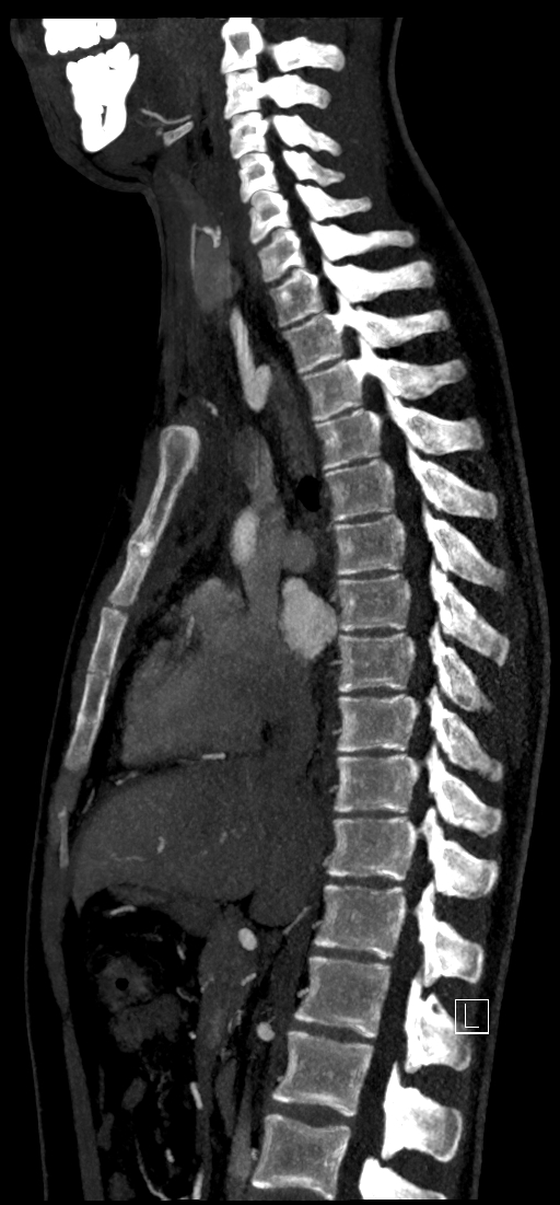 Brachiocephalic trunk pseudoaneurysm (Radiopaedia 70978-81191 C 46).jpg