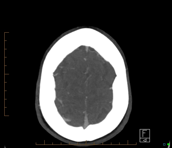 Brachiocephalic trunk stenosis (Radiopaedia 87242-103519 A 8).jpg