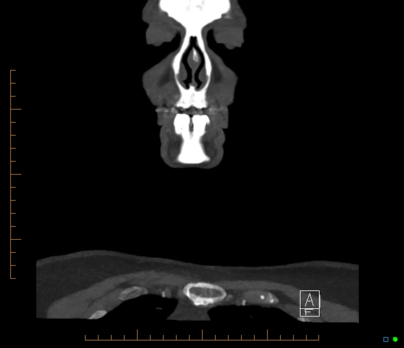 Brachiocephalic trunk stenosis (Radiopaedia 87242-103519 B 2).jpg