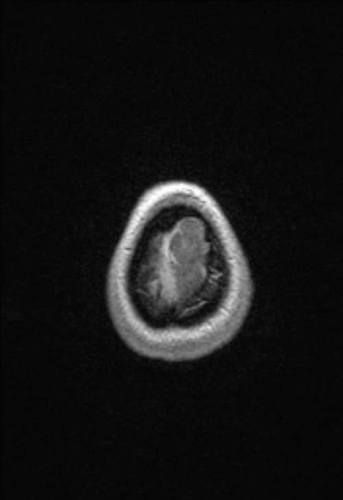 Brain abscess with ventriculitis (Radiopaedia 85703-101495 Axial T1 C+ 159).jpg