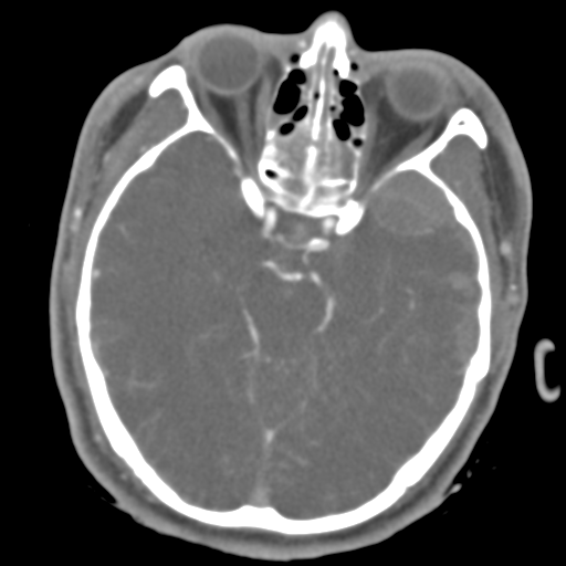 Brain contusions, internal carotid artery dissection and base of skull fracture (Radiopaedia 34089-35339 D 34).png