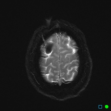 File:Brain death on MRI and CT angiography (Radiopaedia 42560-45689 Axial ADC 28).jpg