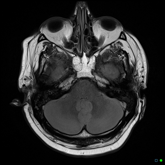File:Brain death on MRI and CT angiography (Radiopaedia 42560-45689 Axial FLAIR 5).jpg
