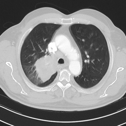 Brain metastasis (large cystic mass) (Radiopaedia 47497-52104 Axial lung window 15).png