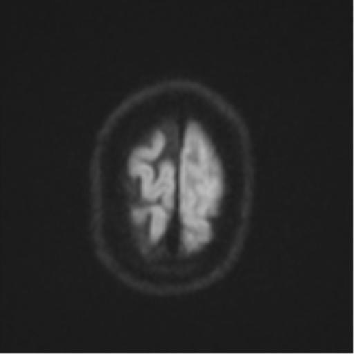 Brain metastasis (lung cancer) (Radiopaedia 48289-53179 Axial DWI 54).png